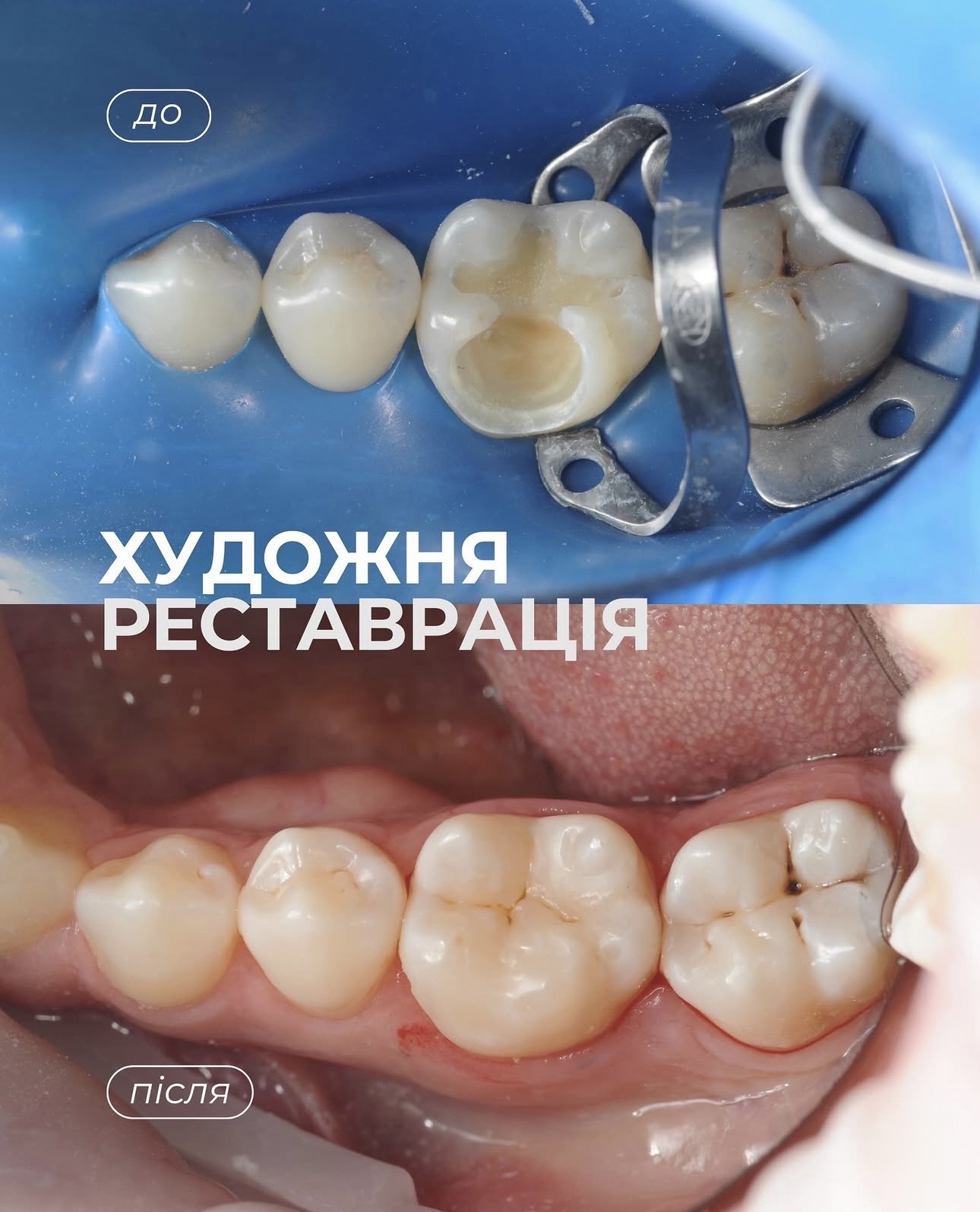 Кейс 5: Художня реставрація жувального зуба