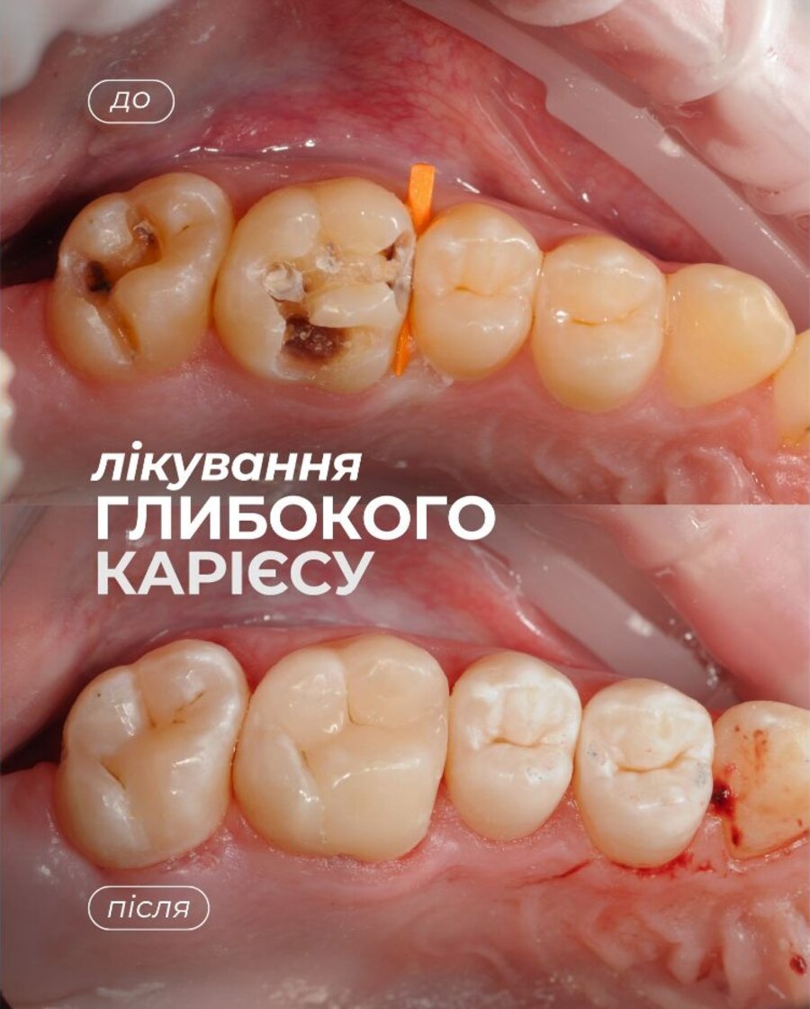 Кейс 6: Відновлення зуба після карієсу