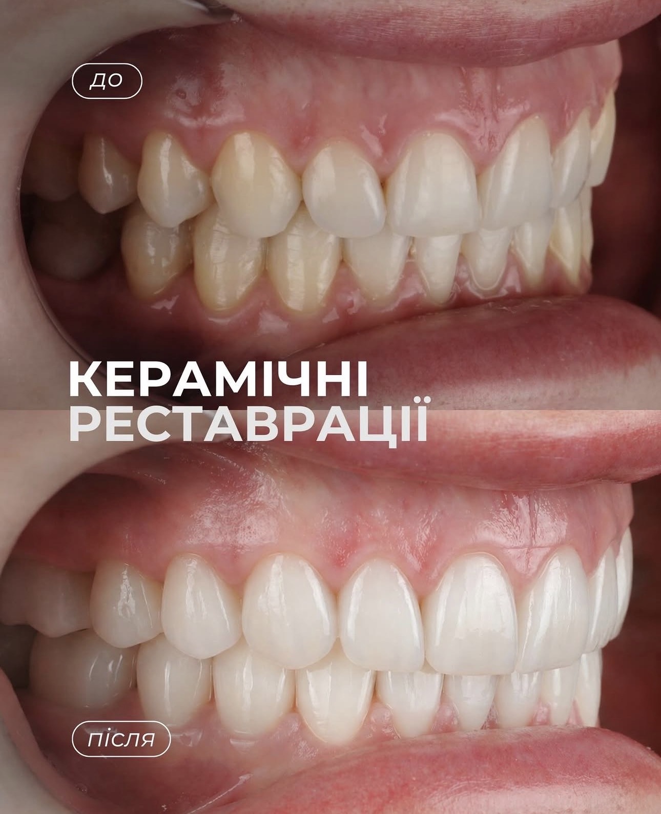 Кейс 2: Керамічні реставрації