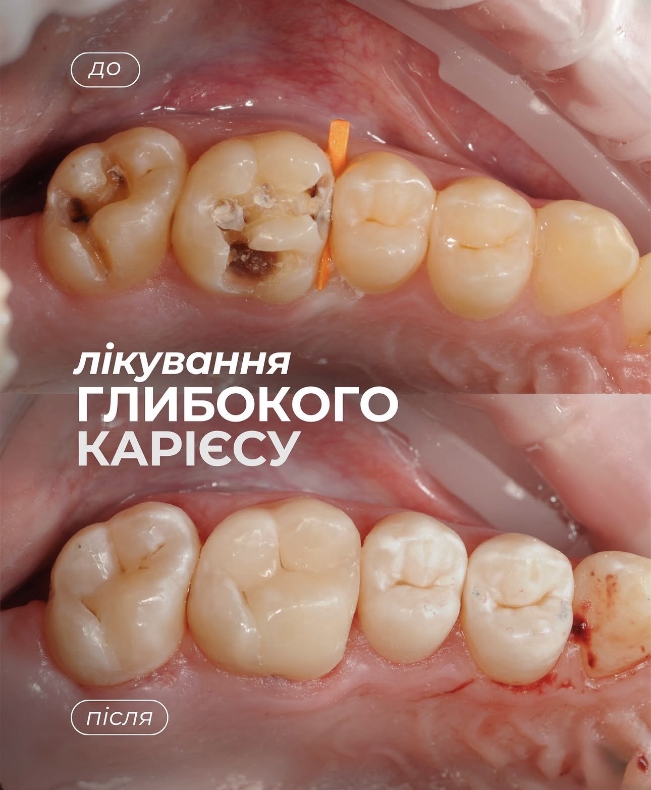 Кейс 4: Лікування глибокого карієсу