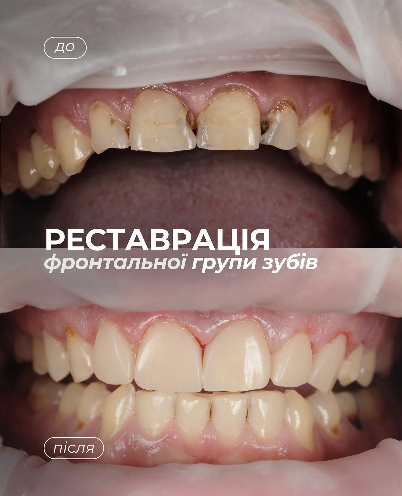Кейс 3: Реставрація фронтальної групи зубів