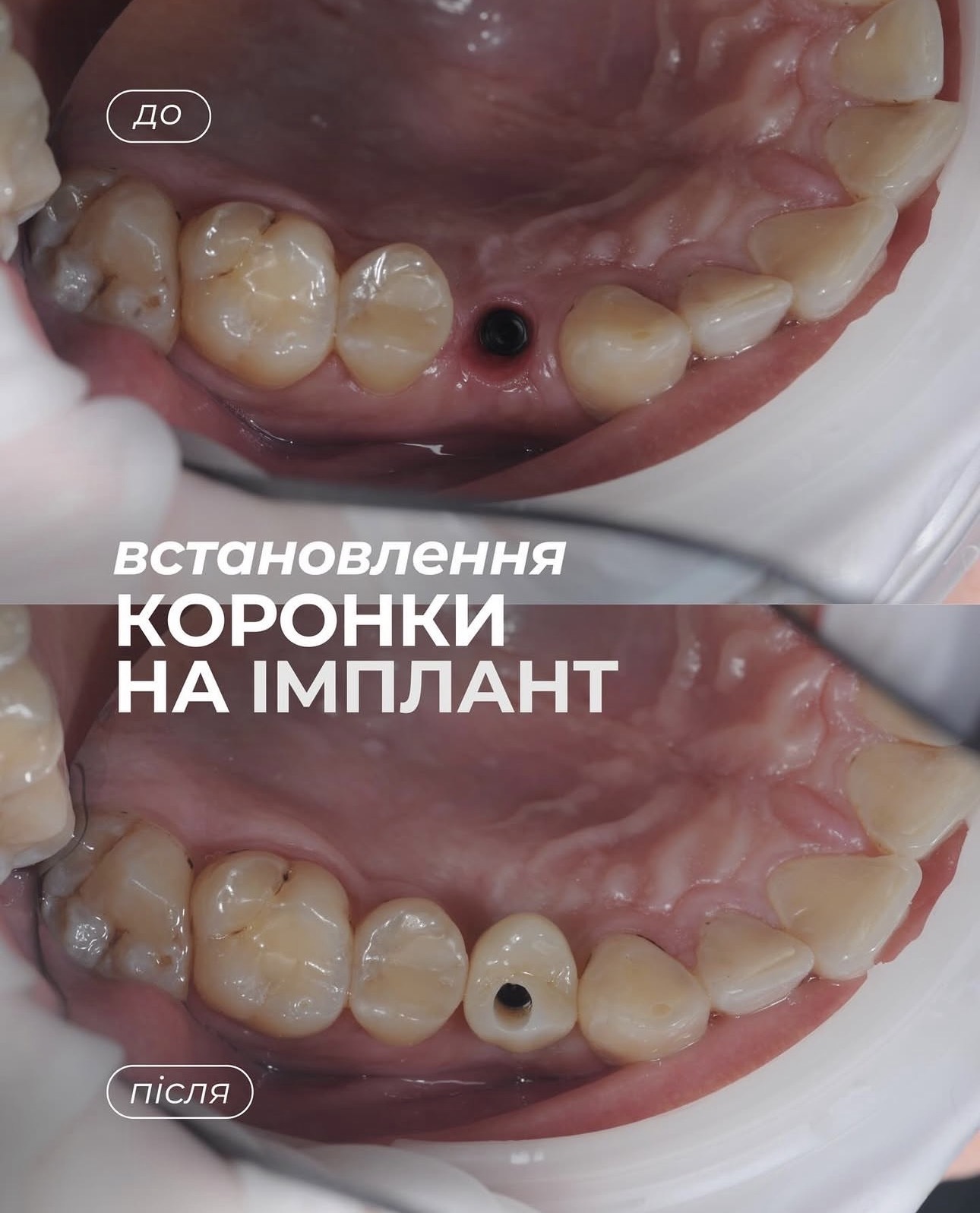 Кейс 1: Коронка на імпланті